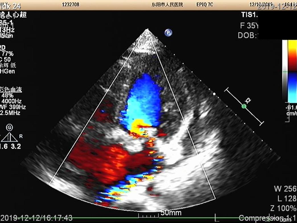 快看!心脏“漏了个洞”,人竟然还活着……