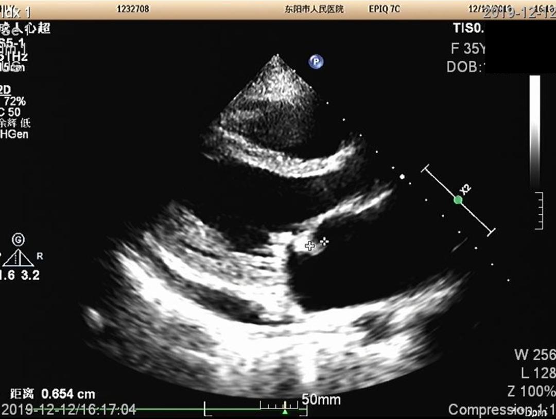 快看!心脏“漏了个洞”,人竟然还活着……