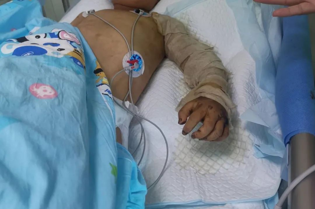 男孩摸了下“花蘑菇”，整个手变黑差点没命！夏天千万当心它