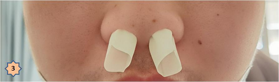 张口性呼吸矫正器效果图,医用全自动张口训练器