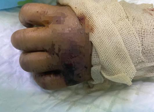 男孩摸了下“花蘑菇”，整个手变黑差点没命！夏天千万当心它