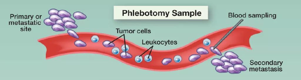 乳腺癌ctc检测,乳腺癌检查CTC是什么
