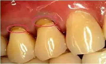 牙颈部楔状缺损,楔状缺损横沟修复