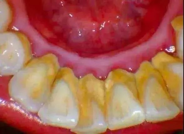 【提醒】OMG！才30多岁，一口牙就要被拔光？有这些症状赶快去看