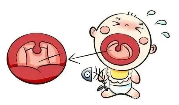 鱼刺卡喉咙了怎么办教你一招,鱼刺卡喉咙怎么办教你一招