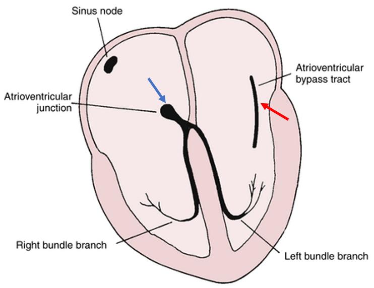 预激综合征无症状,无症状预激需要治疗吗