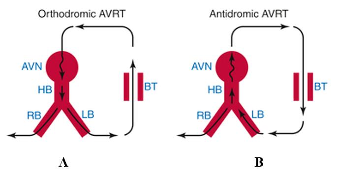 预激综合征无症状,无症状预激需要治疗吗