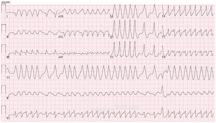 预激综合征无症状,无症状预激需要治疗吗