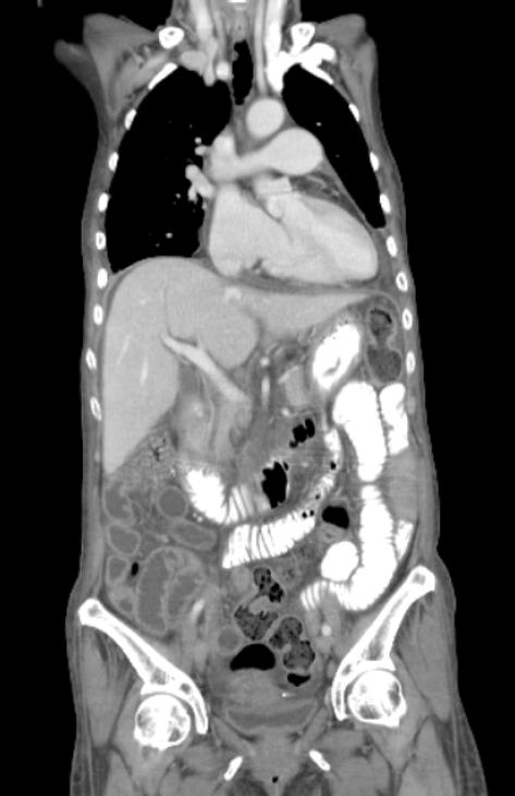 水样腹泻3个月伴发烧，这个病值得引起注意|病例学习