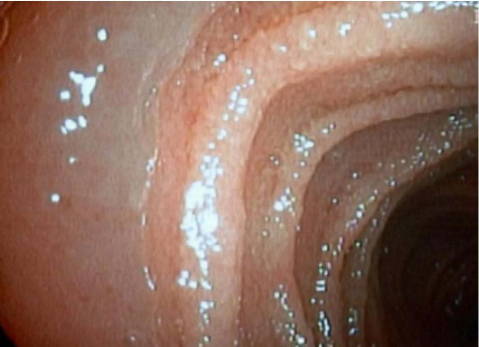 水样腹泻3个月伴发烧，这个病值得引起注意|病例学习
