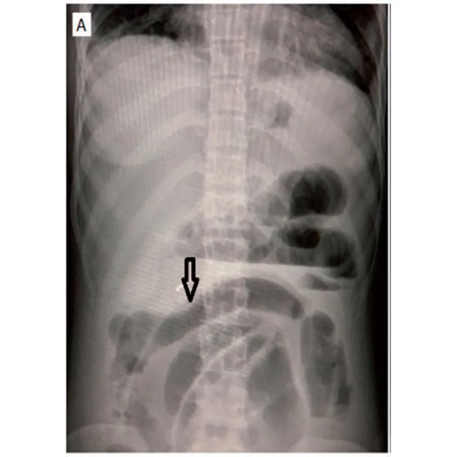 系统性红斑狼疮合并肌炎,系统性红斑狼疮与血管炎