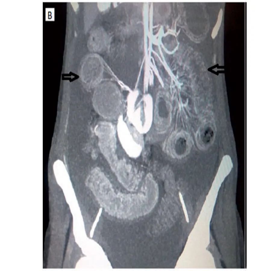 系统性红斑狼疮合并肌炎,系统性红斑狼疮与血管炎