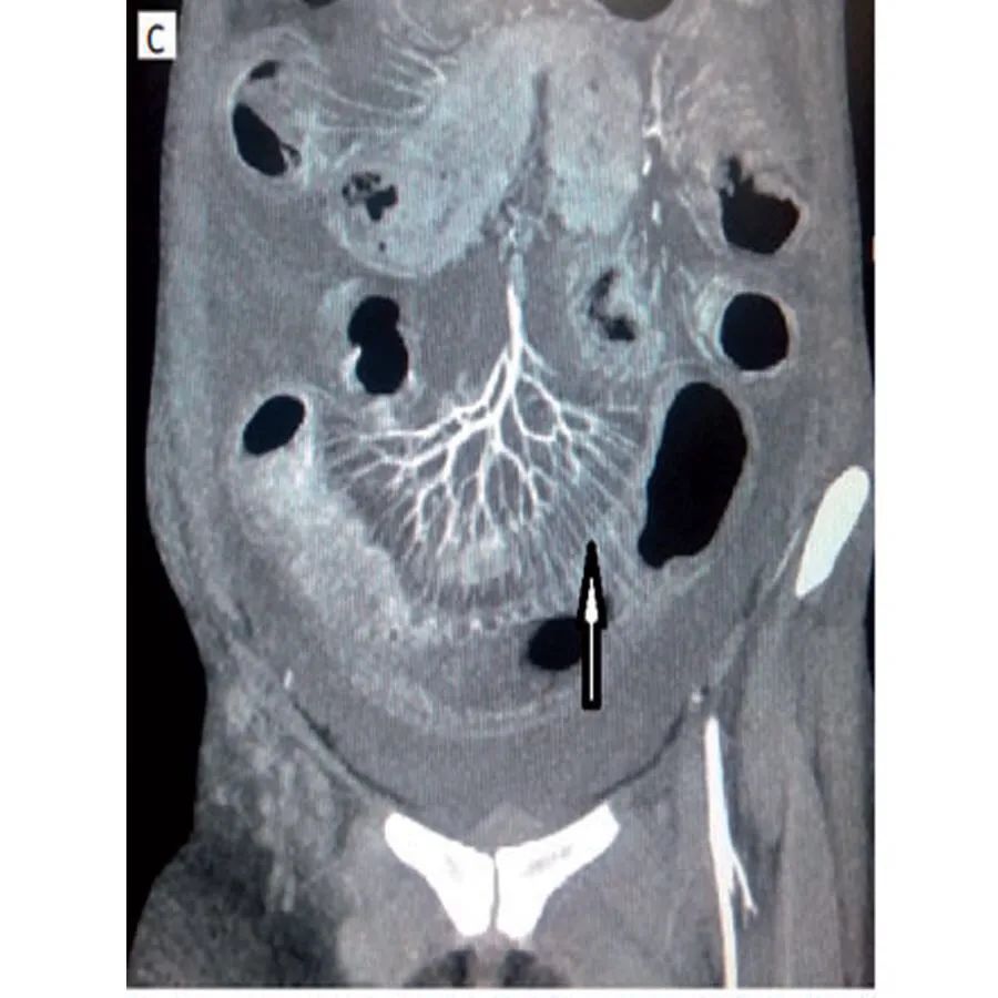 系统性红斑狼疮合并肌炎,系统性红斑狼疮与血管炎