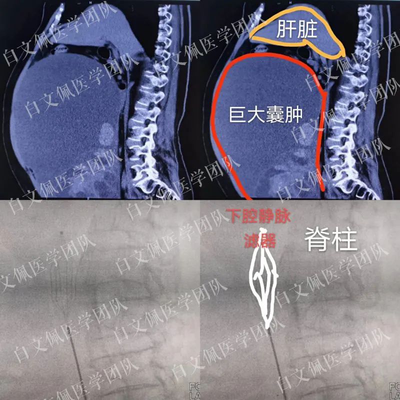盆腔解剖学彩图教学视频,盆腔解剖图谱