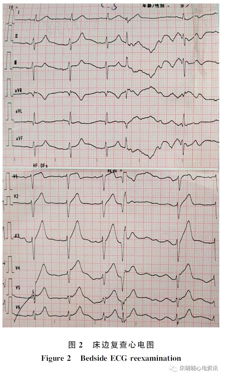 漏诊dewinter综合征,dewinter综合征相关心电图特点