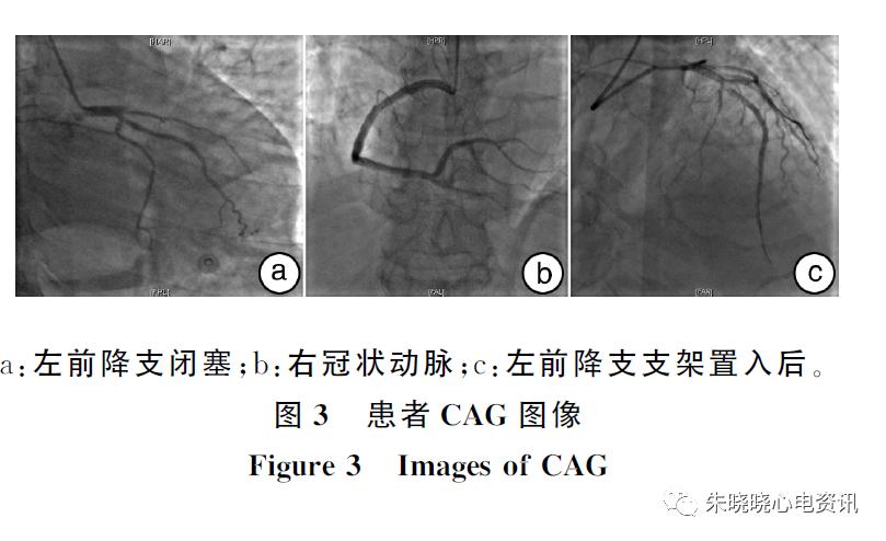 漏诊dewinter综合征,dewinter综合征相关心电图特点