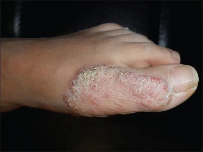 温泉鱼疗真的有用吗,温泉鱼疗有什么害处吗