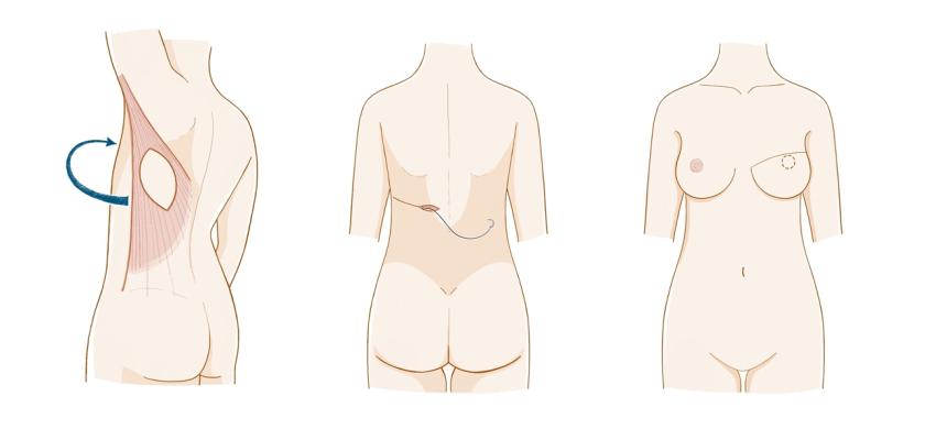 乳房再造最好的方法,乳房再造相关知识