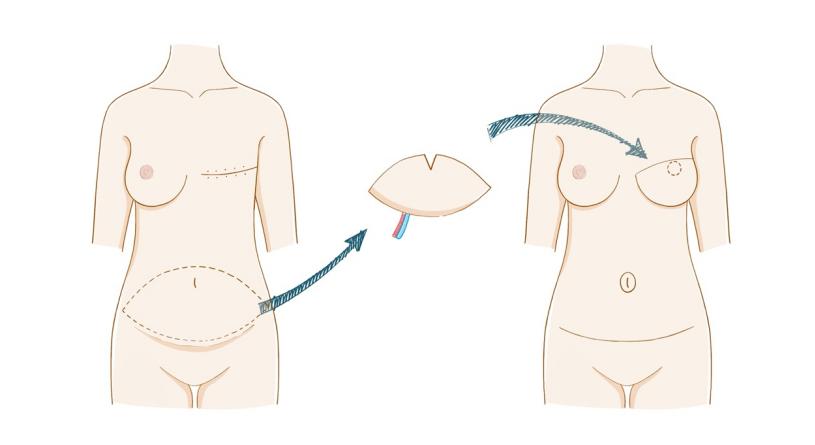 乳房再造最好的方法,乳房再造相关知识