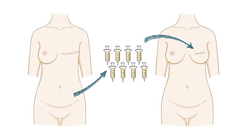 乳房再造最好的方法,乳房再造相关知识