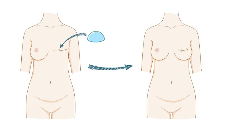 乳房再造最好的方法,乳房再造相关知识