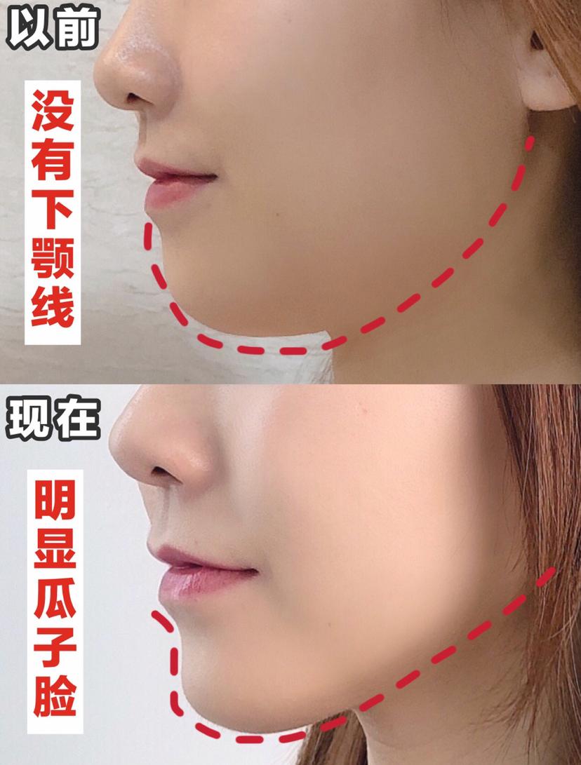 瘦脸小v脸的方法,每天张嘴闭嘴100下能瘦脸吗