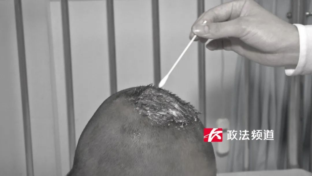 长沙7岁女孩大量脱发，头顶还长出大脓包！原因万万想不到