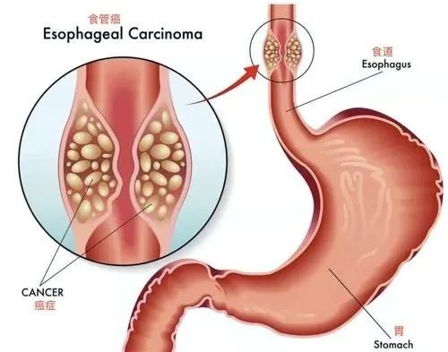 父母吃的食物对身体有害吗,警惕这几类食物有致癌风险