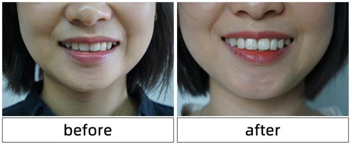 牙齿太黄简单的方法不用花钱,牙齿黄除了洗牙还有什么办法