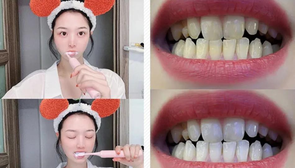 牙齿太黄简单的方法不用花钱,牙齿黄除了洗牙还有什么办法