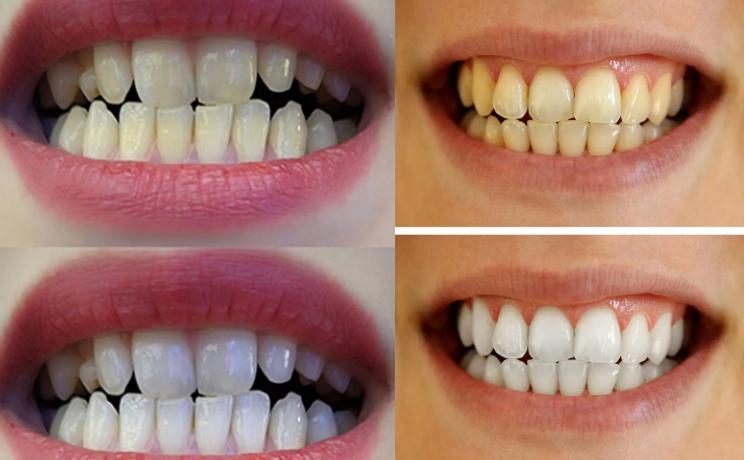 牙齿太黄简单的方法不用花钱,牙齿黄除了洗牙还有什么办法