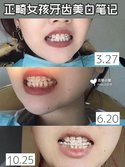 牙齿太黄简单的方法不用花钱,牙齿黄除了洗牙还有什么办法