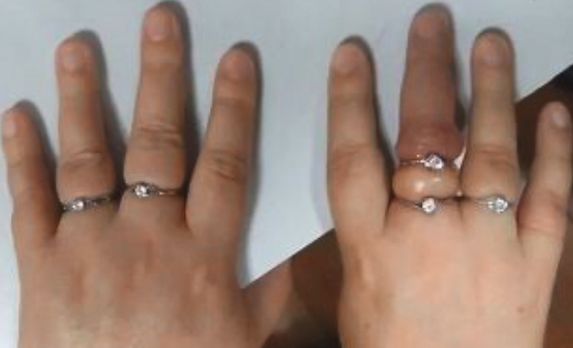 男孩摸了下“花蘑菇”，整个手变黑差点没命！夏天千万当心它