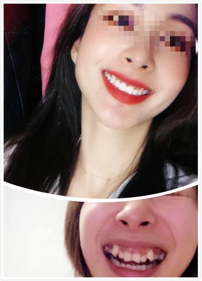 昆明龅牙矫正哪家便宜,长沙成人隐形牙齿矫正龅牙