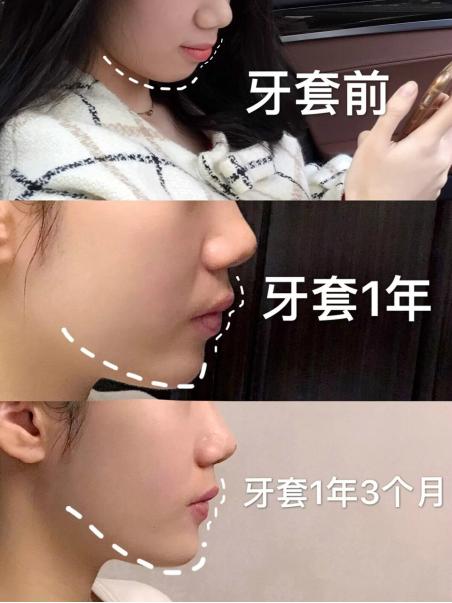 昆明龅牙矫正哪家便宜,长沙成人隐形牙齿矫正龅牙