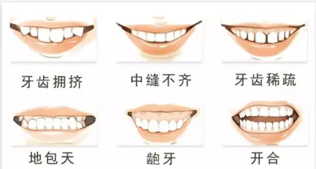 昆明龅牙矫正哪家便宜,长沙成人隐形牙齿矫正龅牙