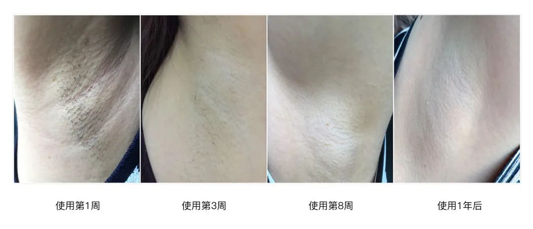 胸毛、脚趾毛、*处私**的毛能不能脱?一篇说清楚