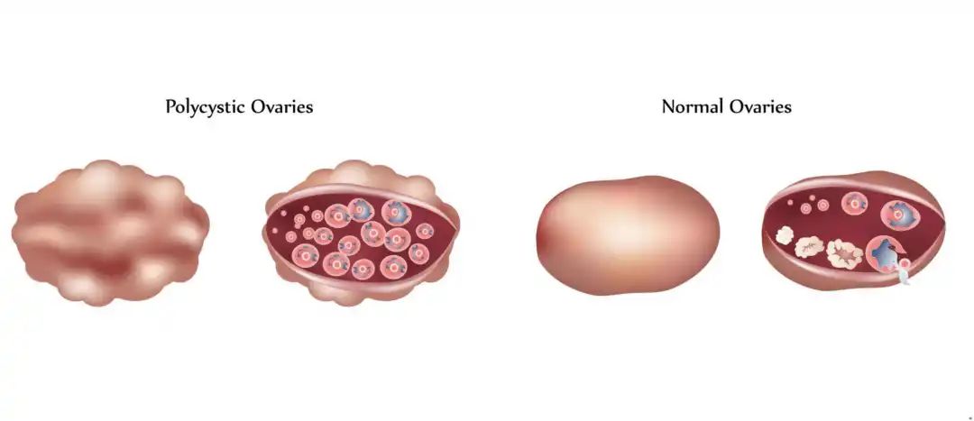 多囊卵巢的科普文章,多囊卵巢综合征综述选题