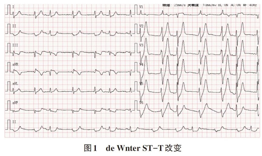 dewinter综合征临床意义,dewinter综合征表现