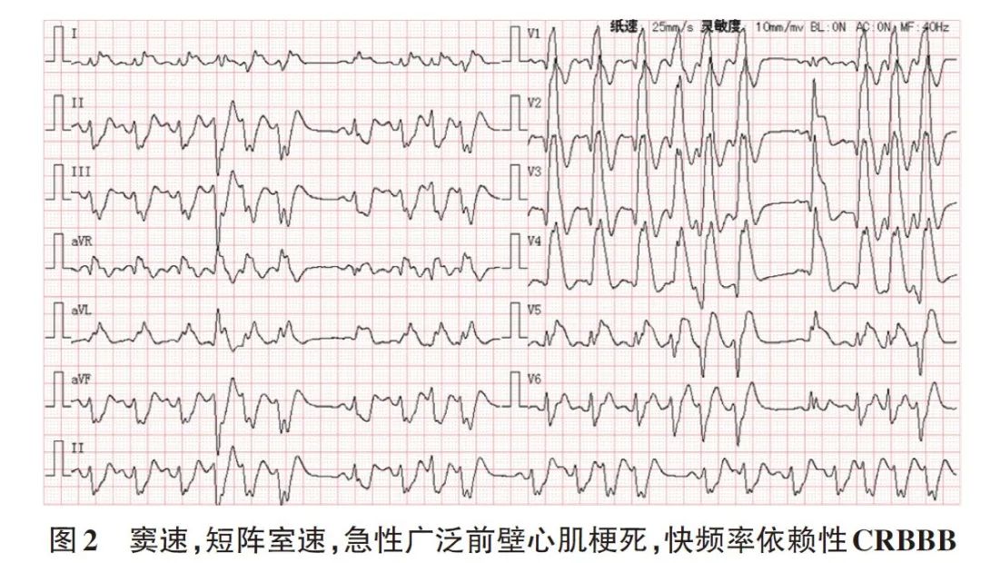 dewinter综合征临床意义,dewinter综合征表现