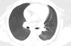新冠病毒中医方案,新冠少阳辨证