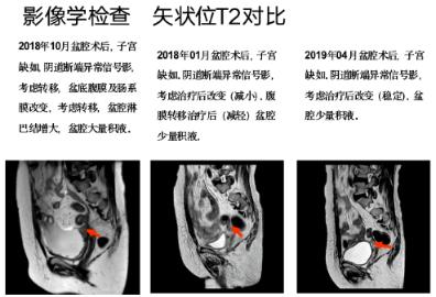 吴瑾教授组稿|刘文涛教授：晚期卵巢癌病例分享