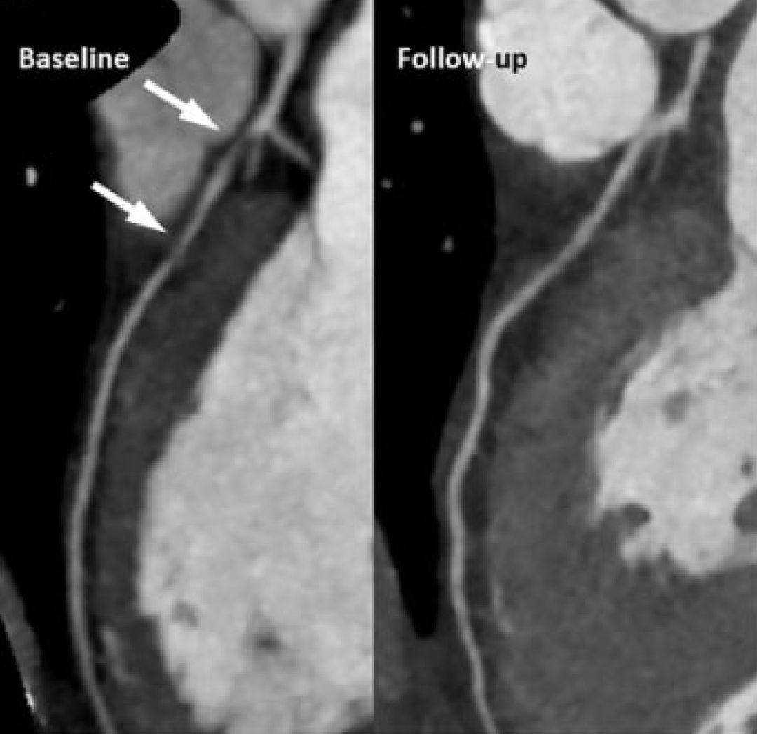 逆转动脉硬化,生酮饮食可以逆转动脉粥样硬化