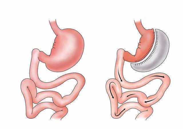 杨天真切胃手术,杨天真糖尿病是几型的