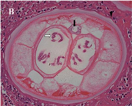 51岁老刘臀部包块不断长大，华山感染专家：是非洲来的“偷渡客”
