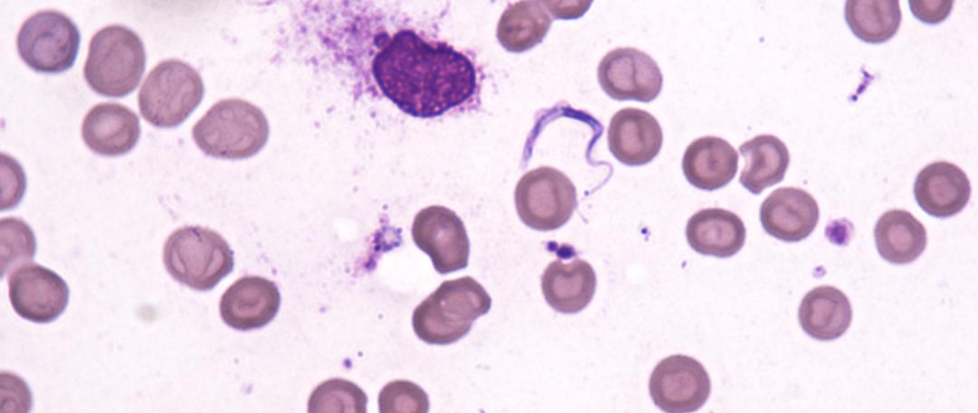 51岁老刘臀部包块不断长大，华山感染专家：是非洲来的“偷渡客”