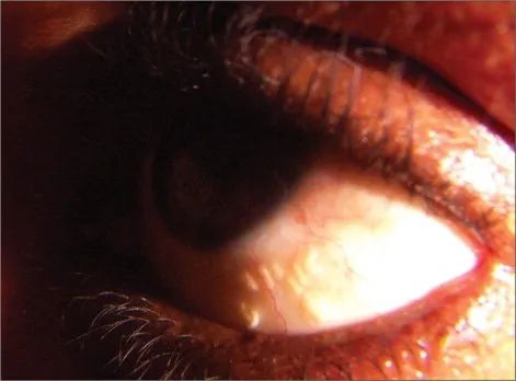 51岁老刘臀部包块不断长大，华山感染专家：是非洲来的“偷渡客”