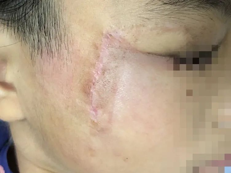 【专家在身边】右脸大面积黑斑，还长毛发！2年多的精心治疗，让大眼萌娃有了正常肤色