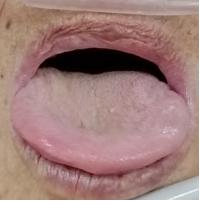 新冠肺炎冠状病毒,新型冠状病毒肺炎中医医案精选