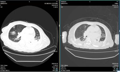 新冠肺炎冠状病毒,新型冠状病毒肺炎中医医案精选